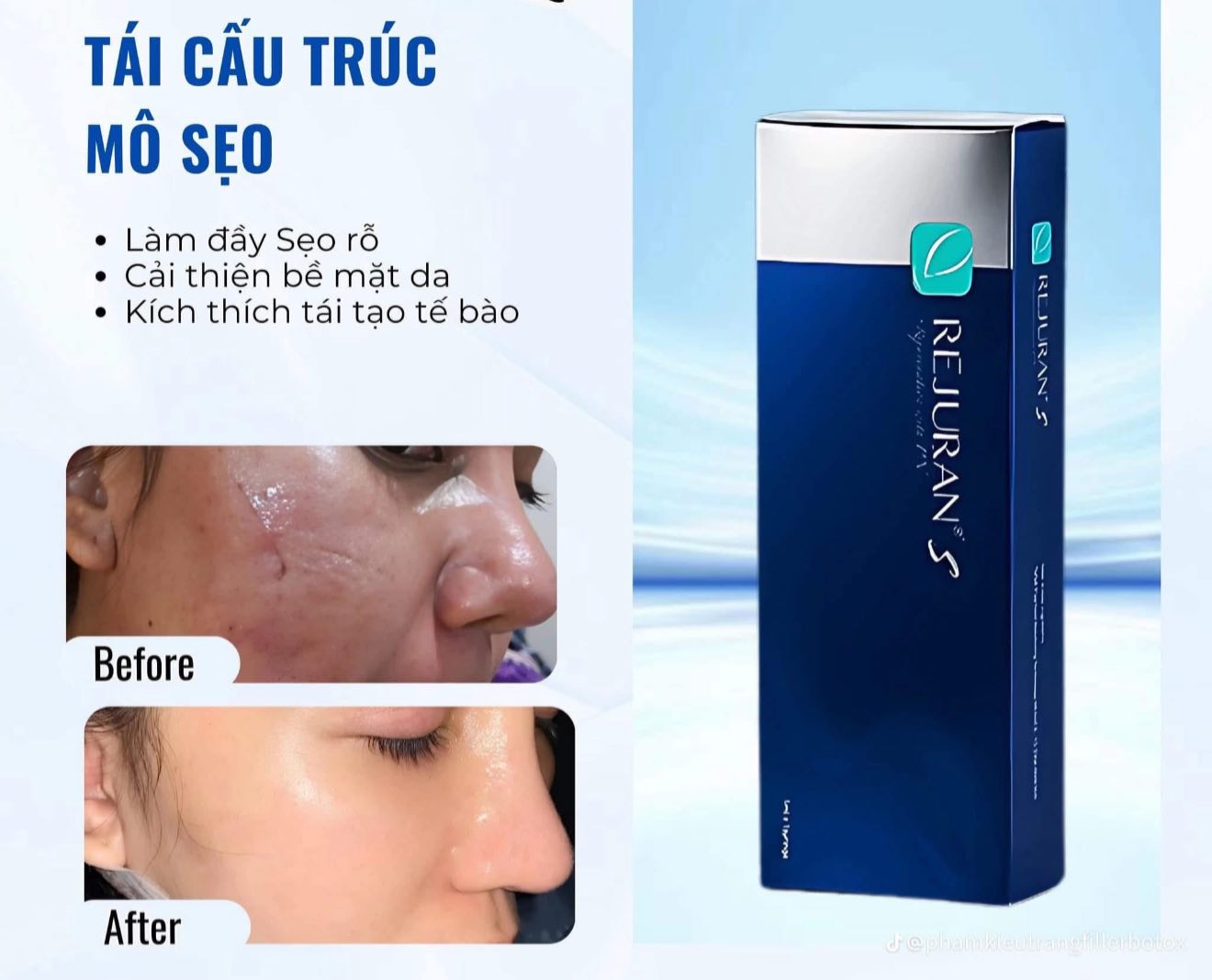 Tiêm meso trị sẹo có hiệu quả không