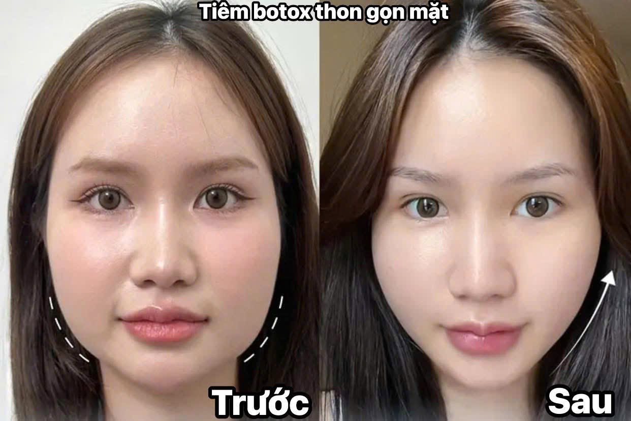 Tiêm thon gọn có giảm mỡ thật không?