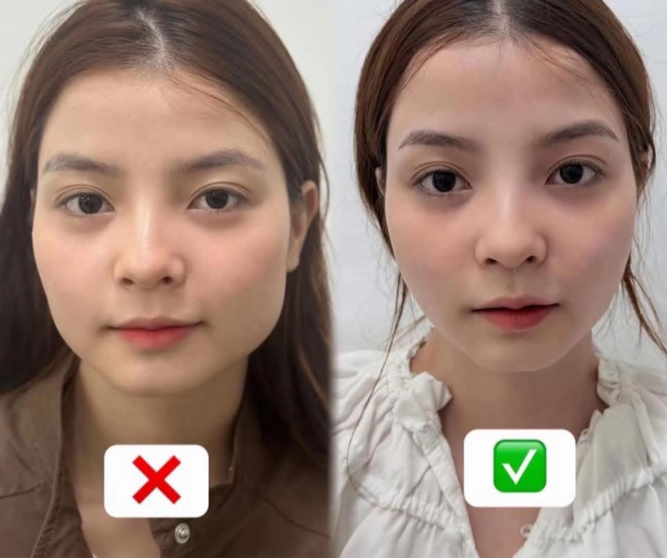 Tiêm thon gọn có giảm mỡ thật không?