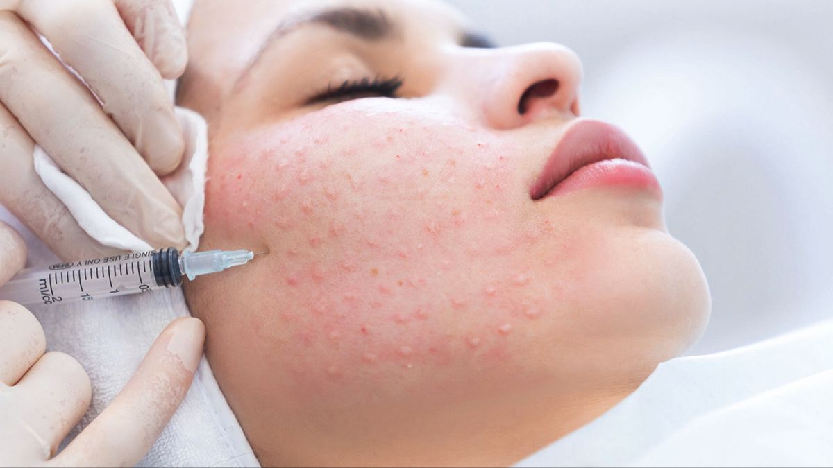 Tiêm Mesotherapy Tại Nhà Giá Rẻ TPHCM: Rủi Ro & Giải Pháp An Toàn