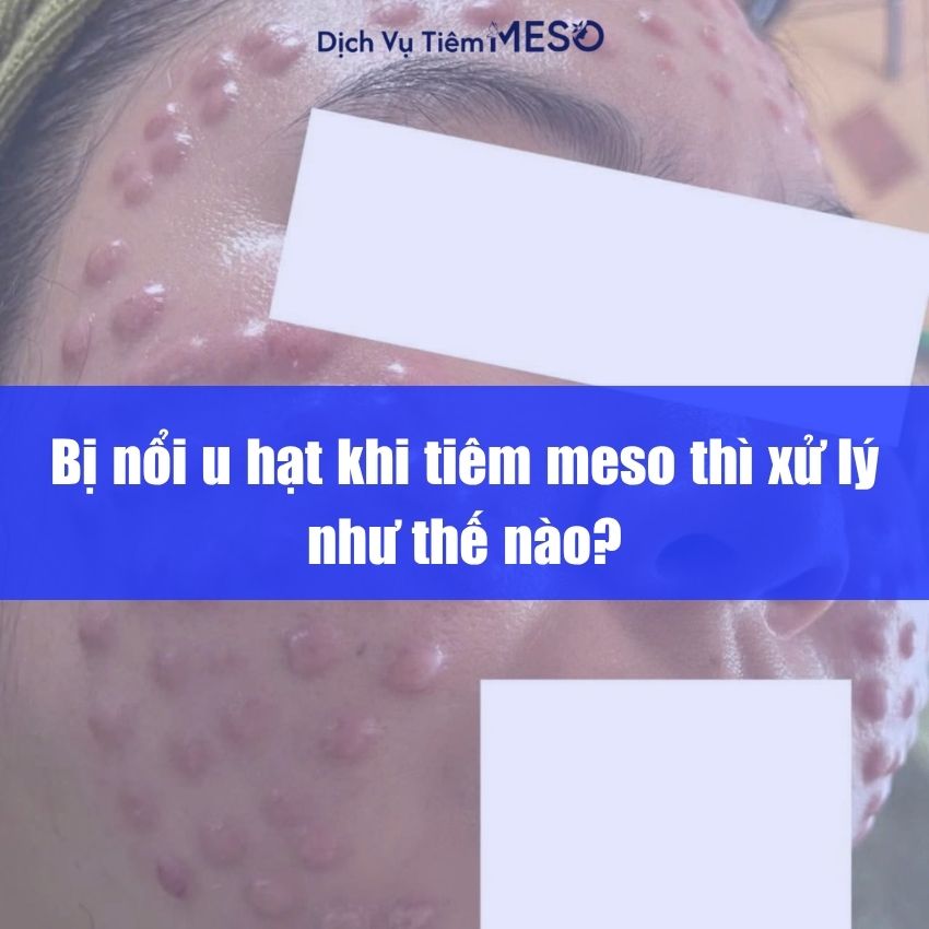 Bị nổi u hạt khi tiêm meso thì xử lý như thế nào?