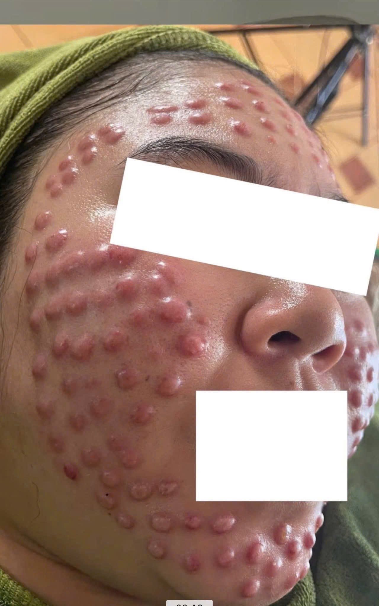 Bị nổi u hạt khi tiêm meso thì xử lý như thế nào