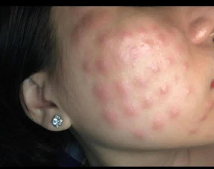 Bị nổi u hạt khi tiêm meso thì xử lý như thế nào