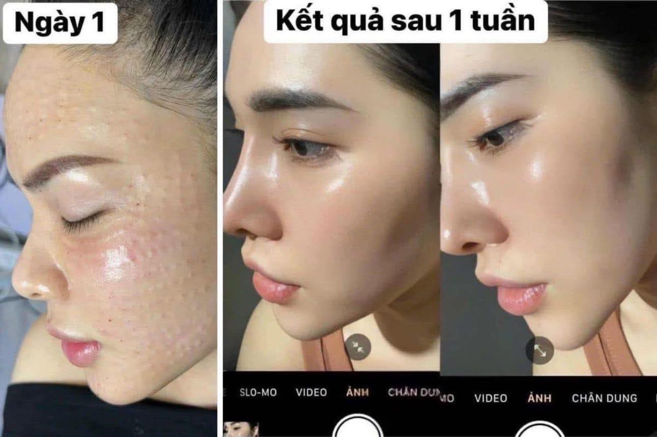 Làn Da Căng Bóng, Mịn Màng Chỉ Sau 1 Liệu Trình Tiêm Meso 