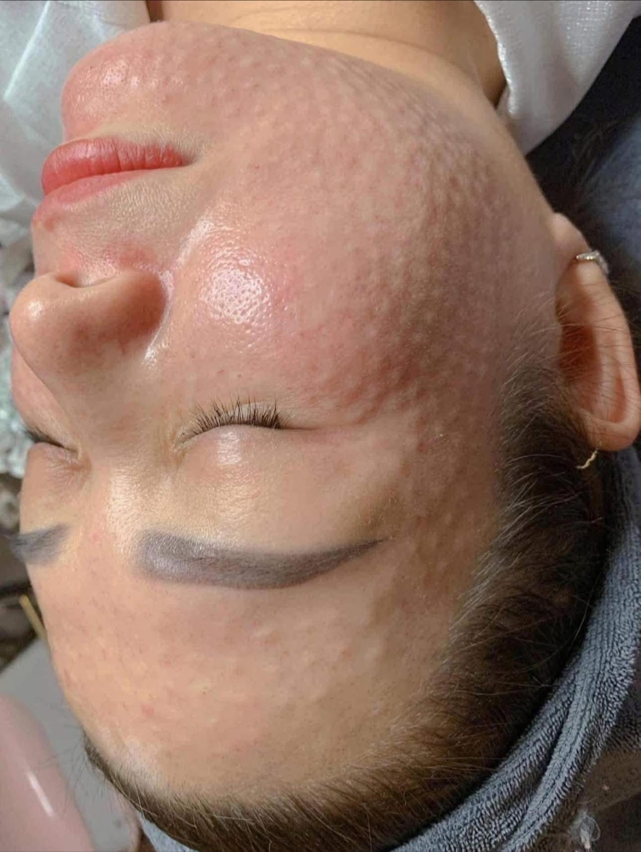 Lần Đầu Tiêm Meso Cần Chú Ý Những Gì