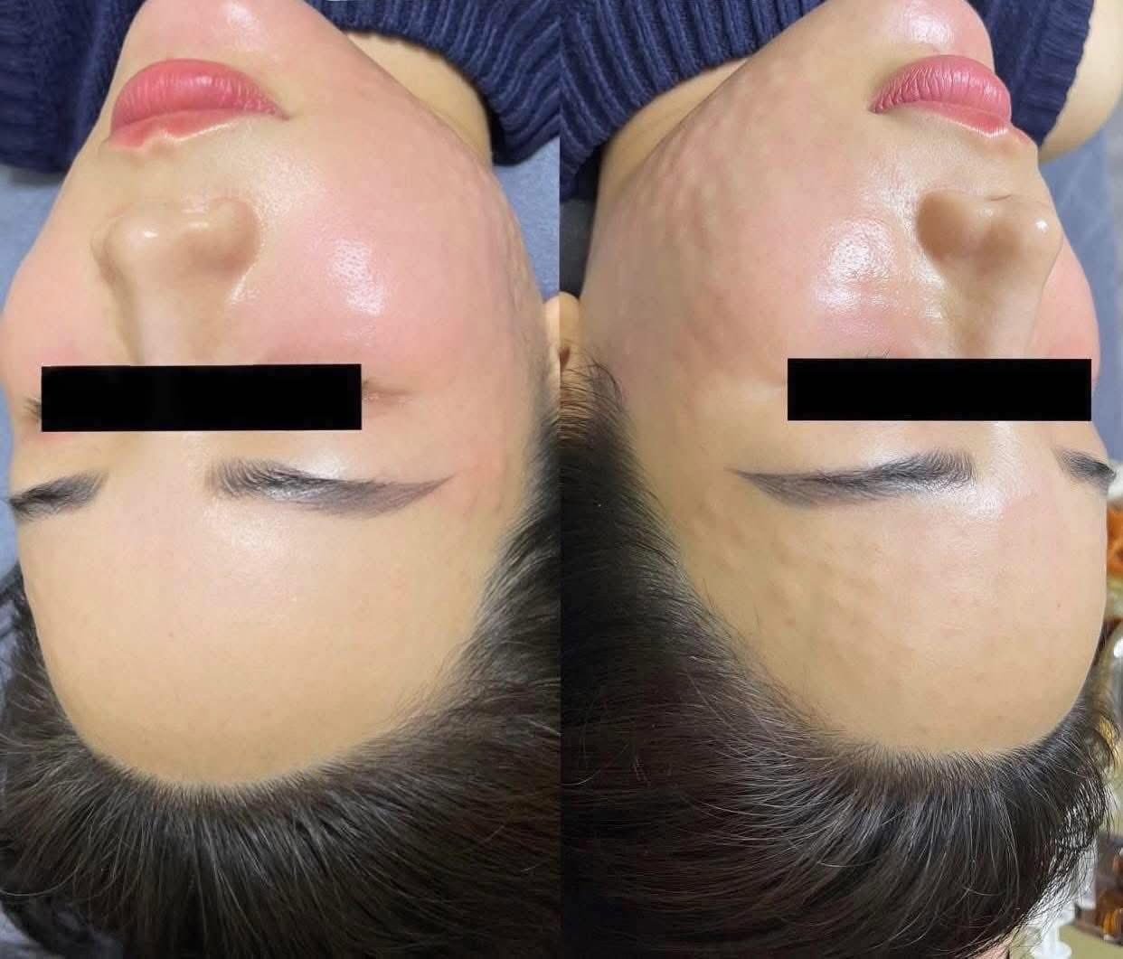 Một năm nên đi tiêm meso bao nhiêu lần