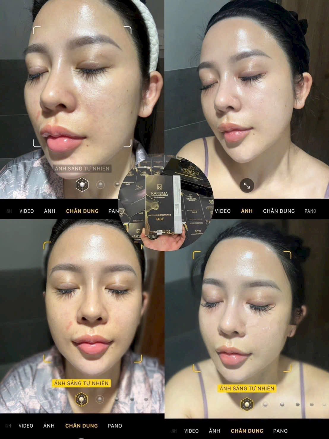 Tiêm BAP Giá Bao Nhiêu