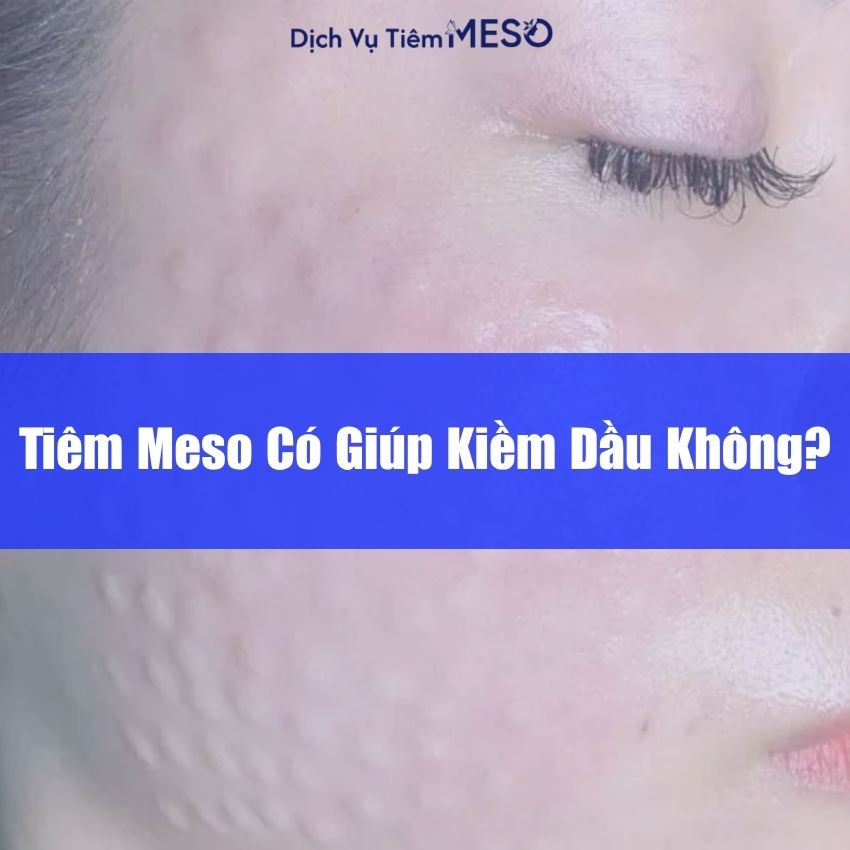 Tiêm Meso Có Giúp Kiềm Dầu Không