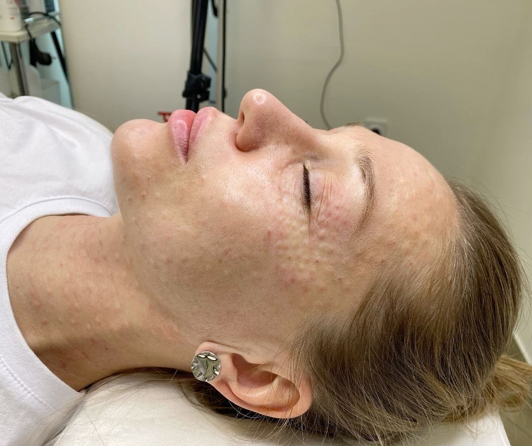 Tiêm Meso Có Giúp Kiềm Dầu Không