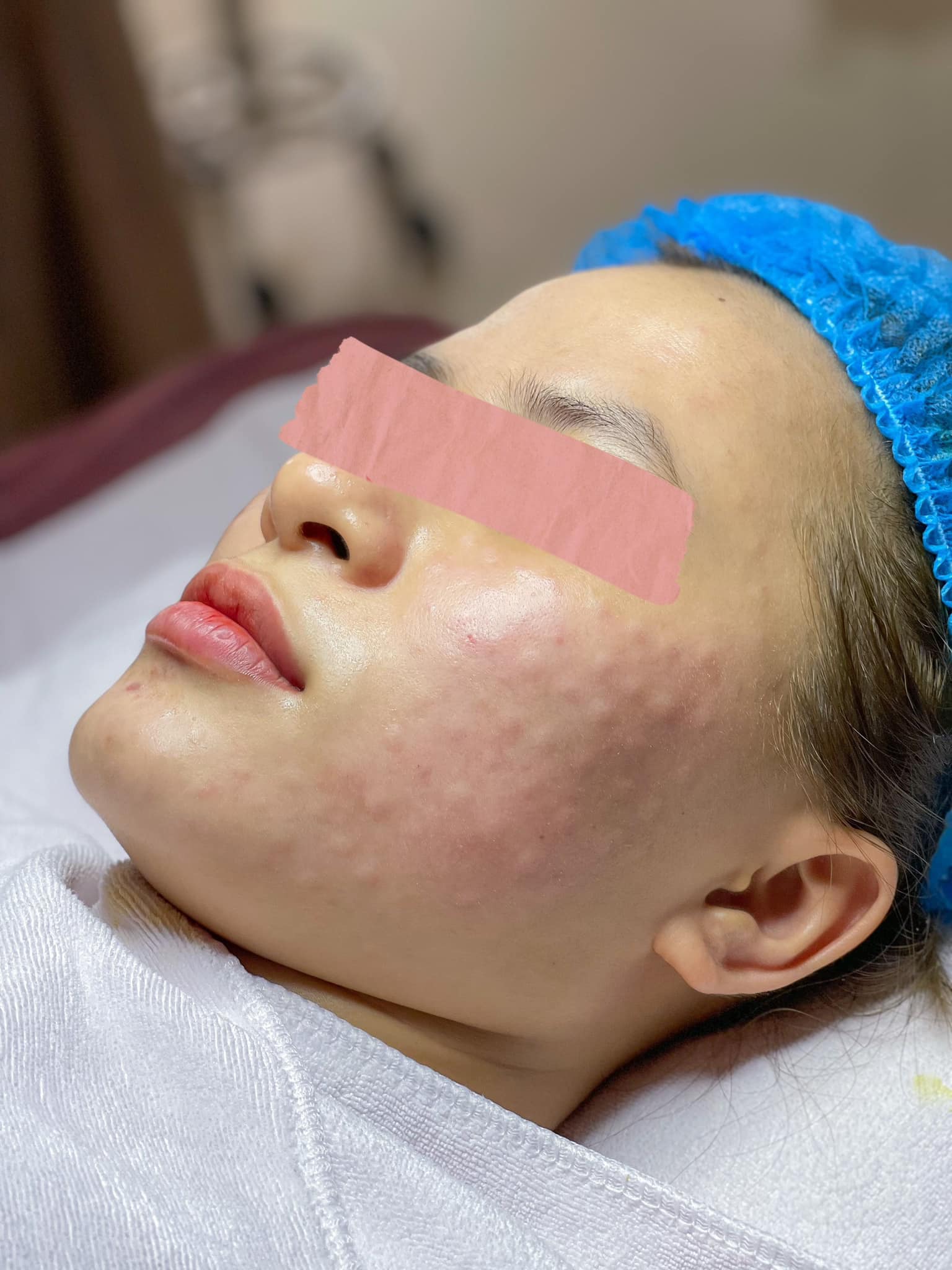 Tiêm Meso Sai Cách Khiến Da Tệ Hơn