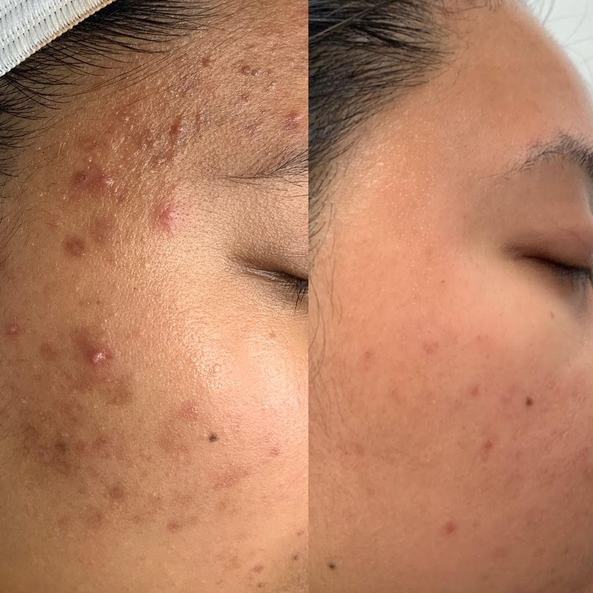 Tiêm Meso Trị Mụn Có Hiệu Quả Không. Sự Thật Nhiều Người Chưa Biết