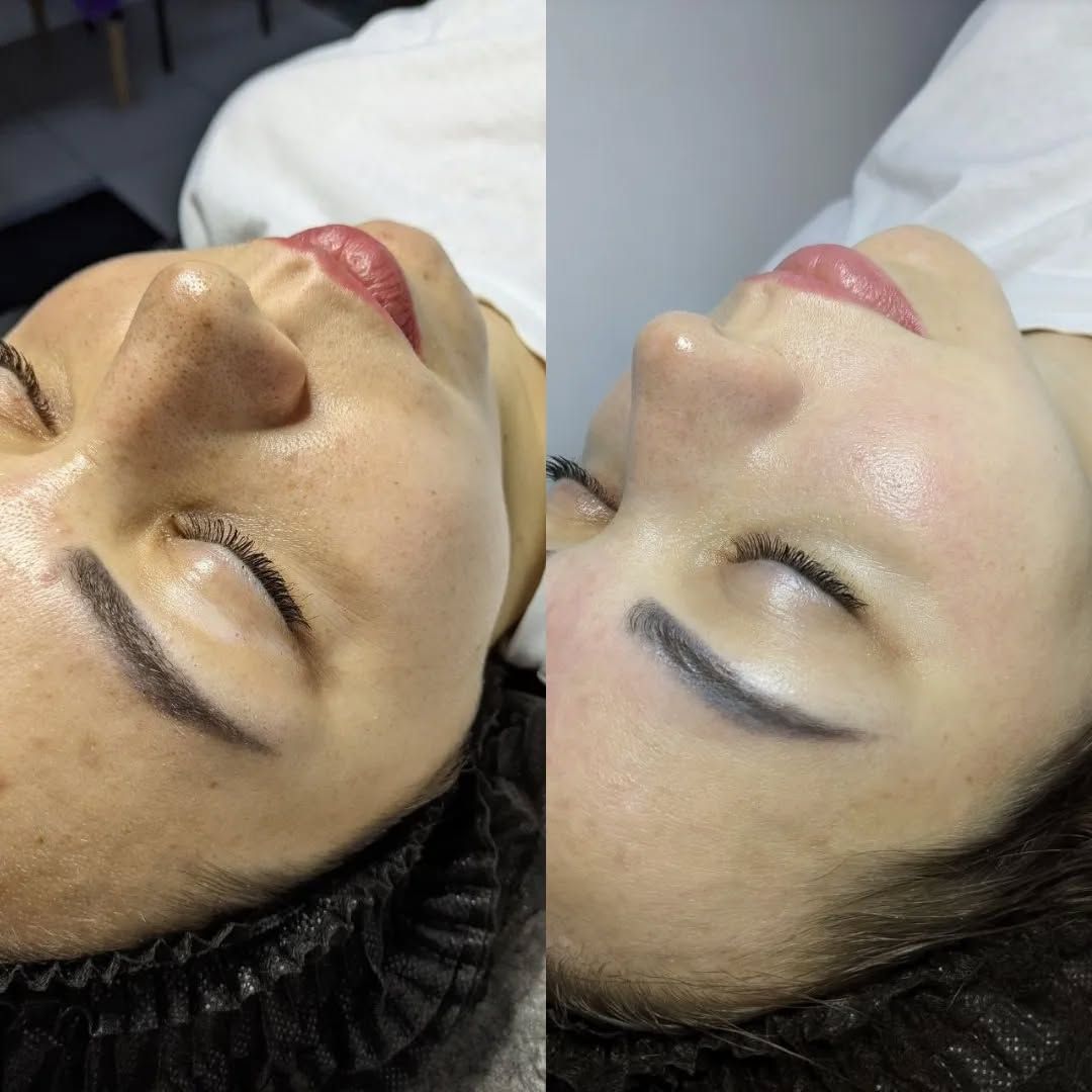 Tiêm Meso Trị Mụn Có Hiệu Quả Không. Sự Thật Nhiều Người Chưa Biết