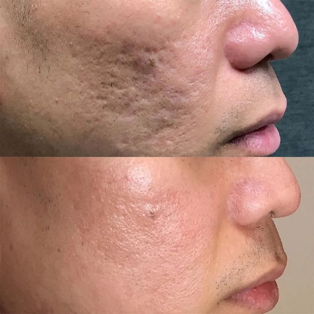 Tiêm Meso Trị Sẹo Có Tác Dụng Gì? 