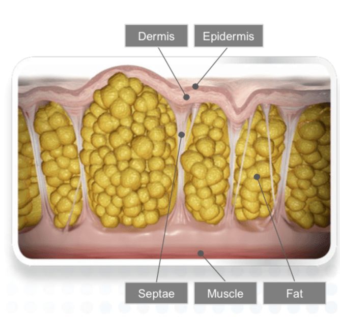 Vì Sao Mỡ Tích Tụ Một Chỗ Rất Khó Giảm. Review Tiêm Meso Tan Mỡ