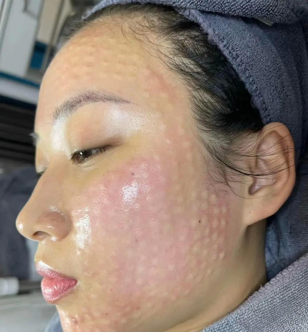 Meso Phục Hồi Da Yếu Sau Treatment Có Hiệu Quả?