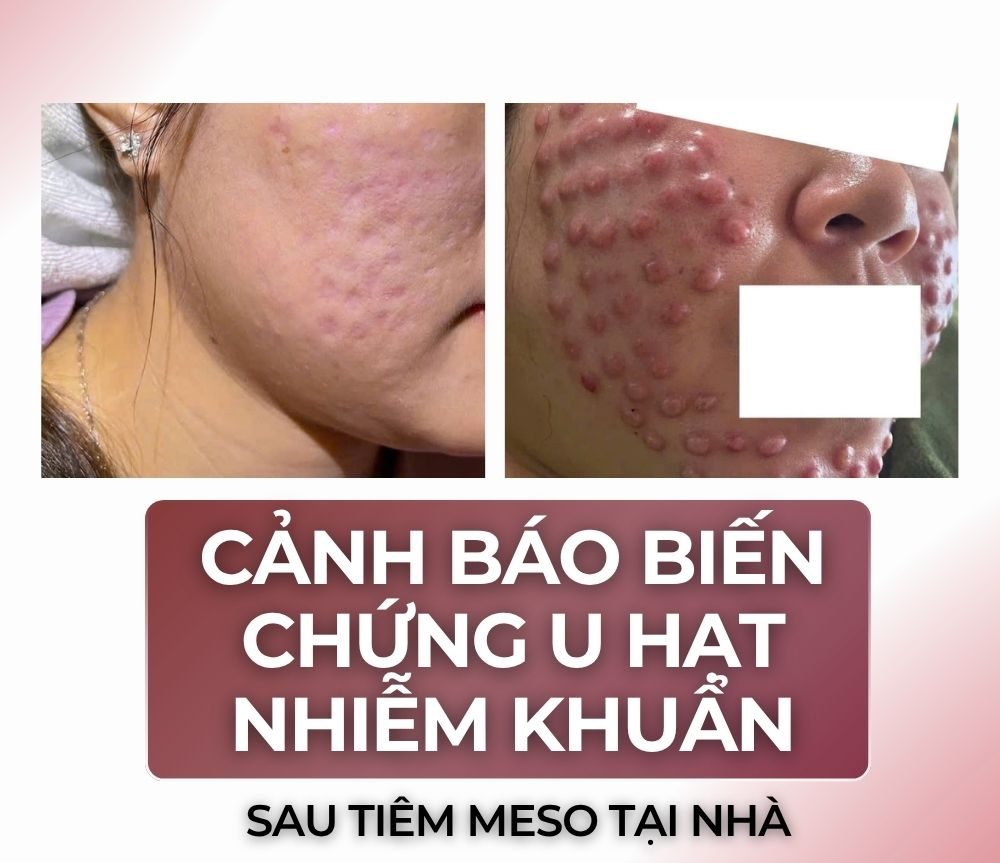 Tiêm Meso Bị U Hạt Thì Do Đâu