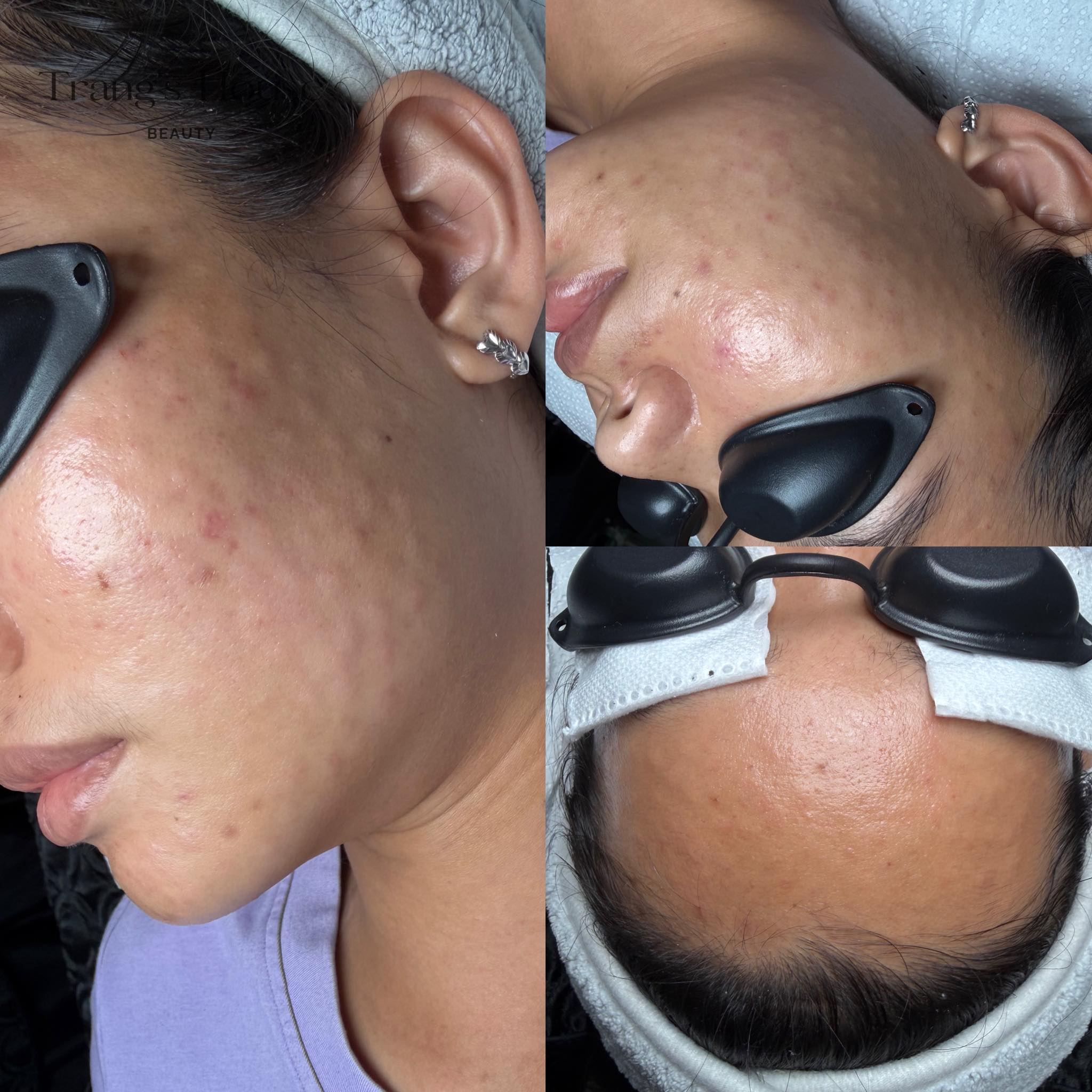 Tiêm Meso Bị U Hạt Thì Do Đâu