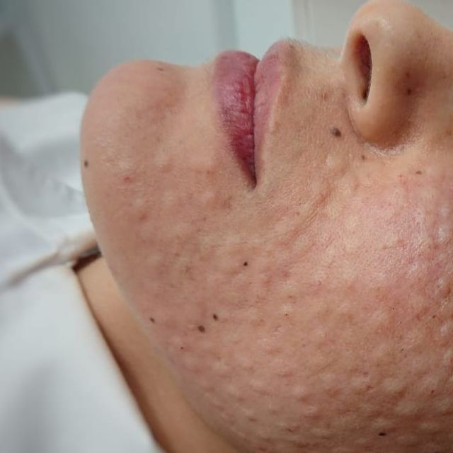 Một Liệu Trình Meso Trị Mụn Bao Nhiêu Buổi