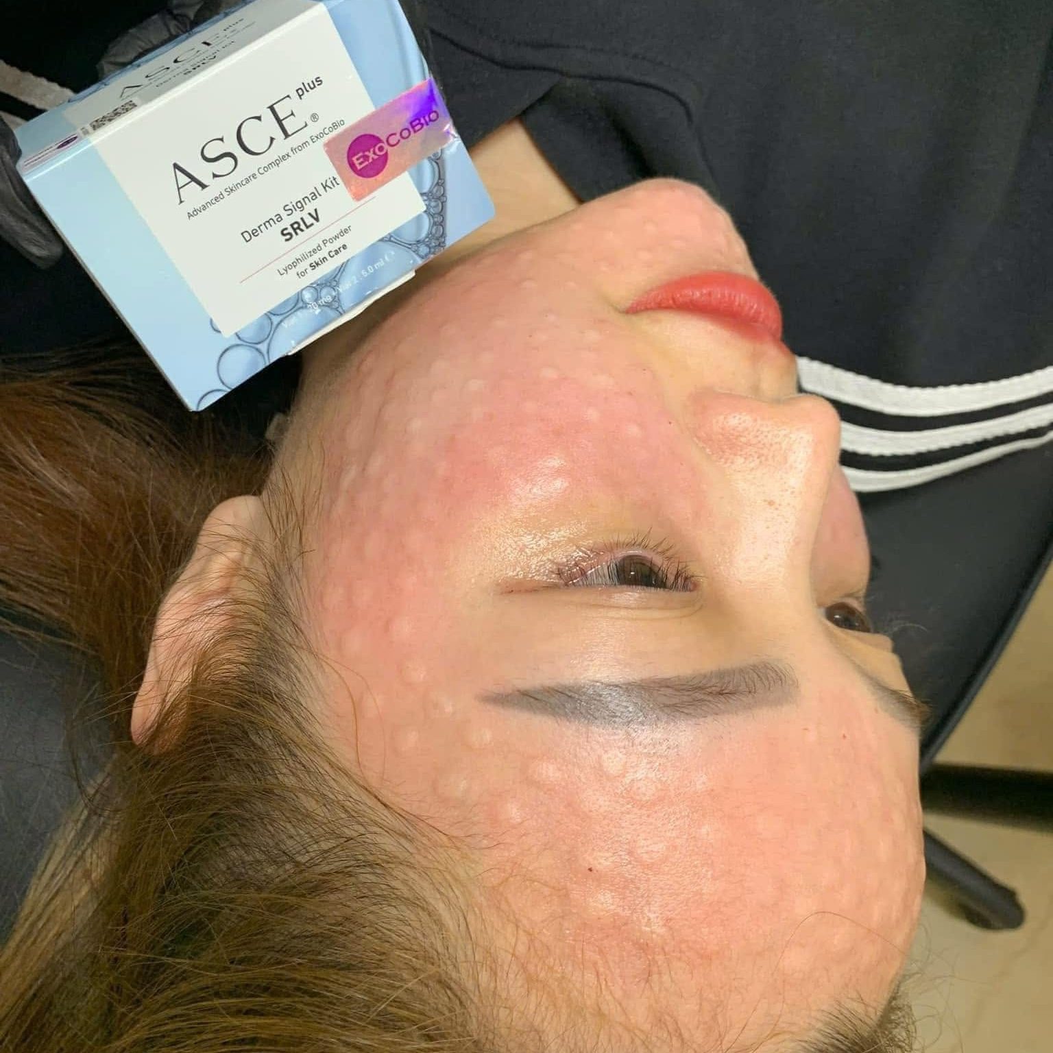 Sau Tiêm Meso Có Được Dùng Retinol Không