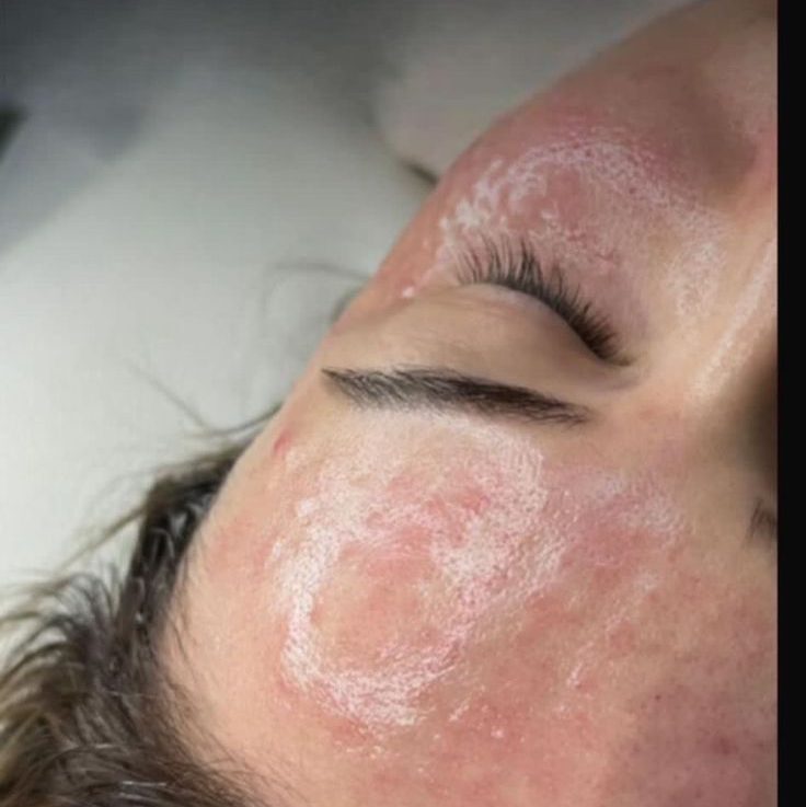 Tiêm Meso Có Là Giải Pháp Cho Người Bận Rộn Muốn Làm Đẹp Nhanh?