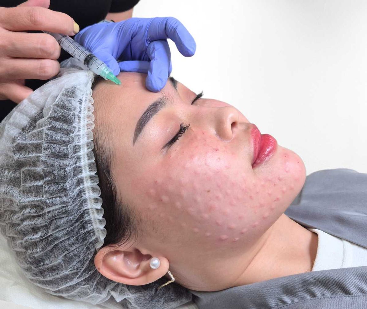 Tiêm Meso Trị Sẹo Rỗ Tại Sao Không Hiệu Quả