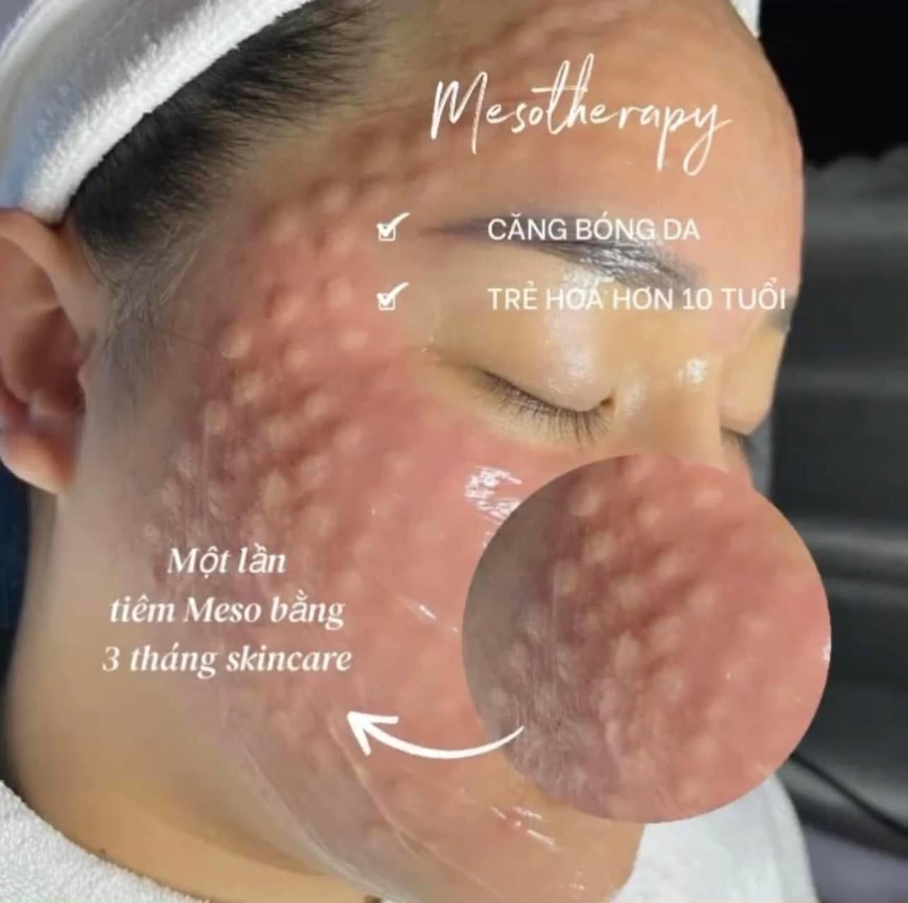 Tiêm meso có giúp hết thâm mụn không