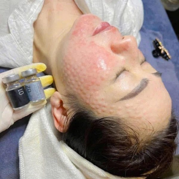 Tiêm meso phục hồi cho da yếu, da mỏng đỏ có hiệu quả không? 