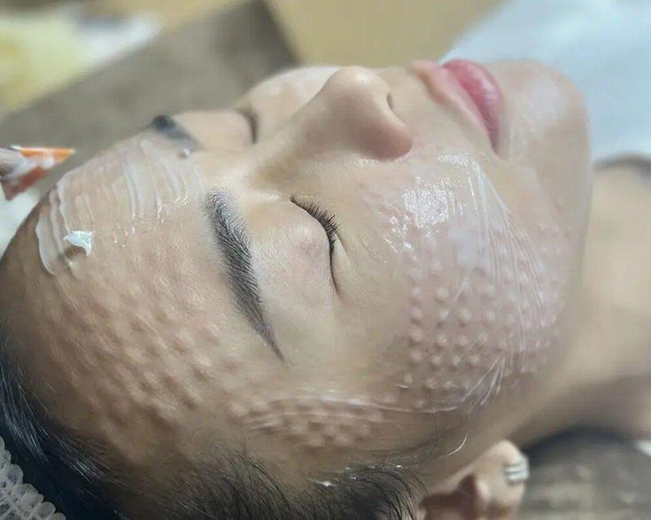 Vì Sao Sau Tiêm Meso Da Bị Đỏ